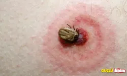 Lyme hastalığı nedir ölümcül müdür?