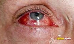 Kırmızı Göz hastalığı belirtisi nedir? Kırmızı Göz hastalığı nasıl geçer? Kırmızı Göz hastalığı bulaşıcı mıdır?