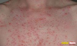 İdiyopatik kronik alerji nedir? Bulaşıcı mı? Tedavisi var mı?