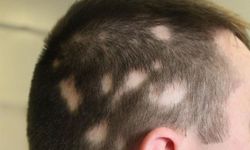 Saçkıranın tedavisi mümkün mü?