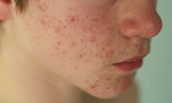 Bahar aylarında cilt sorunları artıyor: Uzmandan kritik uyarılar