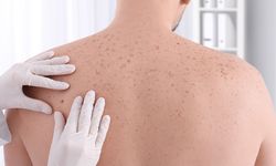 Dermatolojik tarama cilt sağlığınız için hayati öneme sahip!