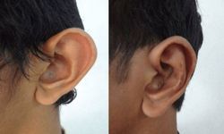 Prof. Dr. Hayati Akbaş: Kepçe kulak tedavisi ertelenmemeli