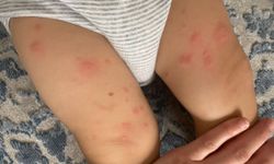 Besin alerjileri çocuklarda hayati tehlike oluşturabiliyor!