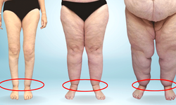 Uzmandan lipödem hastalığına dikkat uyarısı