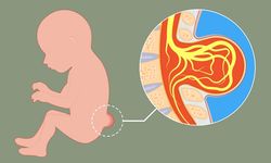 Spina bifida nedir, belirtileri ve tedavi yöntemleri nelerdir?