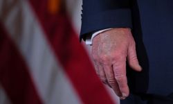 Venöz yetmezlik nedir? Trump gündeme taşıdı