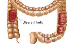 Ülseratif kolit nedir? Belirtileri ve tedavi yöntemleri neler?