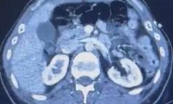 Midesinde yasaklı madde taşıyan 2 şüpheli tespit edildi