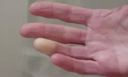 Soğuk ve stres, parmaklarda renk değişikliğine yol açabilir