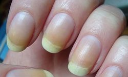 Tırnakta sarı lekeler neden olur?