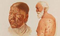 Lepra (cüzzam) hastalığı nedir?