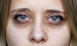 Göz altı morlukları neden olur? Sebepleri neler?