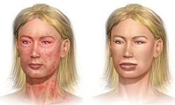 Anafilaktik şok nedir, neden olur? Belirtileri nelerdir?