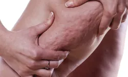 Lipödem hastalığında erken tanı önemli!