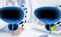 Prostat kanseri 2. sırada: Prostat kanseri nedir?
