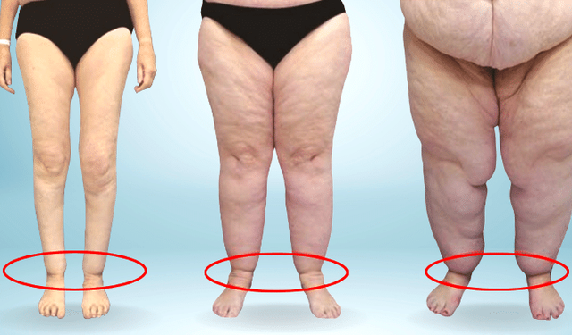 Uzmandan lipödem hastalığına dikkat uyarısı