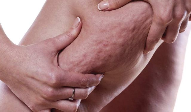 Dr. Hülya Yüksel: Bacaklardaki orantısız yağlanma lipödem belirtisi olabilir