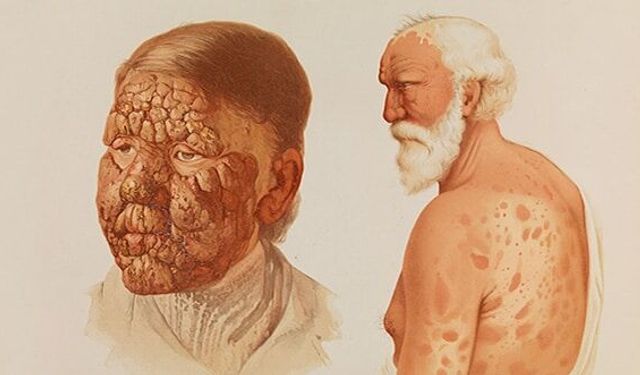 Lepra (cüzzam) hastalığı nedir?