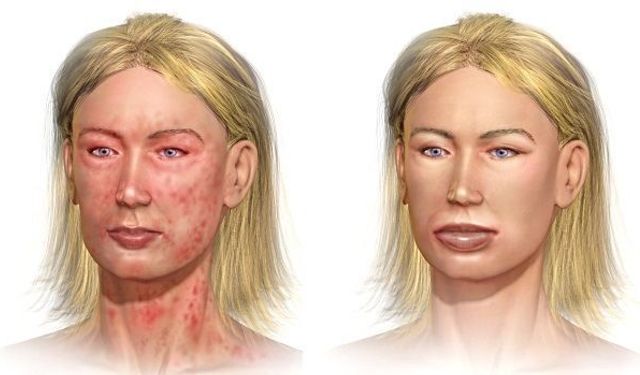 Anafilaktik şok nedir, neden olur? Belirtileri nelerdir?