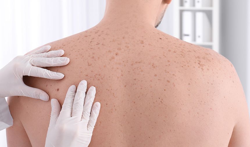 Dermatolojik tarama cilt sağlığınız için hayati öneme sahip!