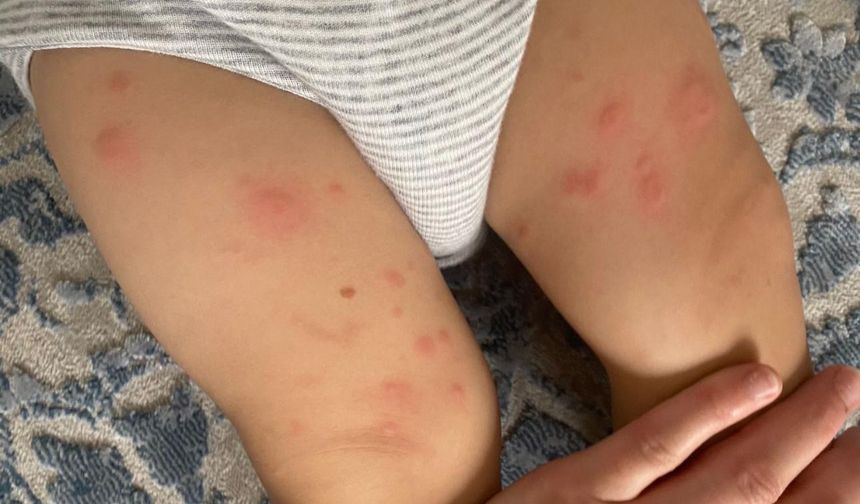 Besin alerjileri çocuklarda hayati tehlike oluşturabiliyor!