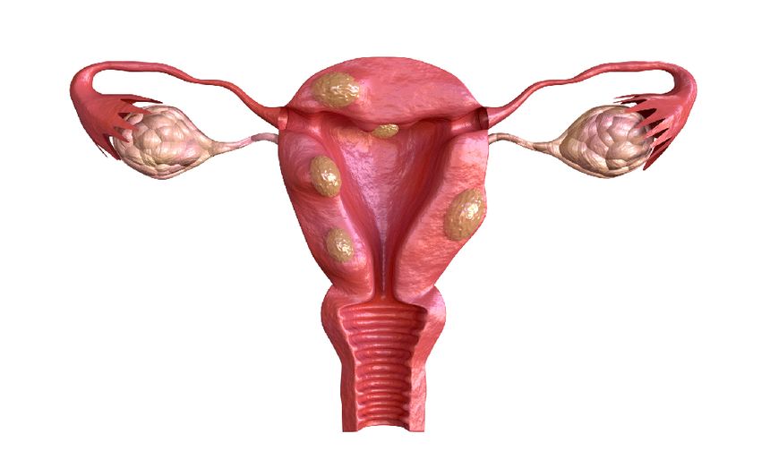 Dermoid kist nedir? Belirtileri neler?