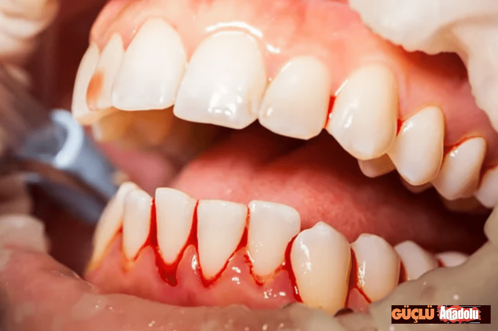 Is-Gum-Disease-Serious-1024x681