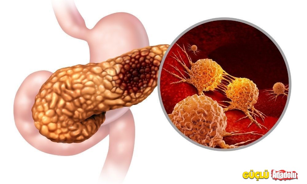 Akut Ve Kronik Pankreatit Nedir