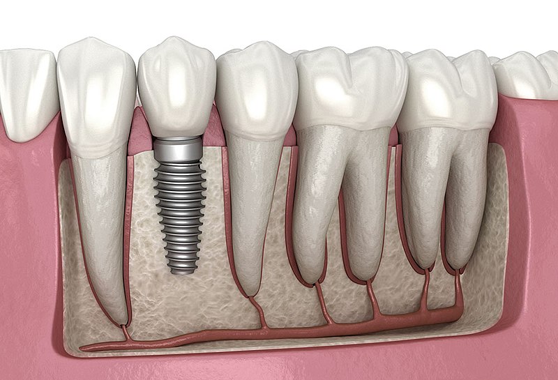 Implant1