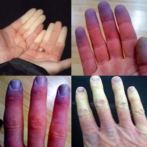 Raynaud3