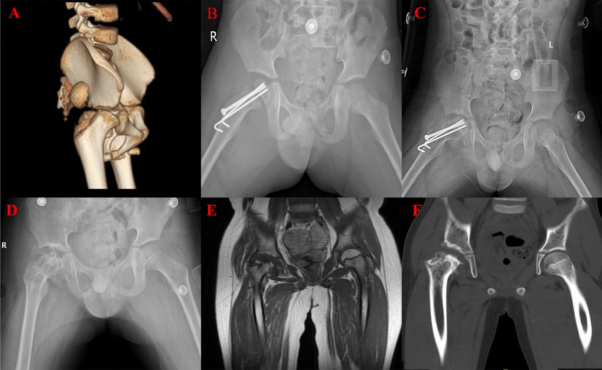 Kalça Çıkığı (1)