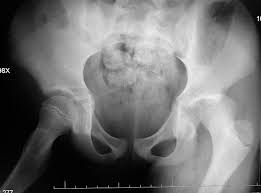 Kalça Çıkığı (2)