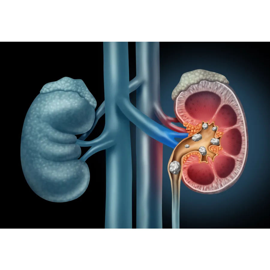 Böbrek Taşı (2)