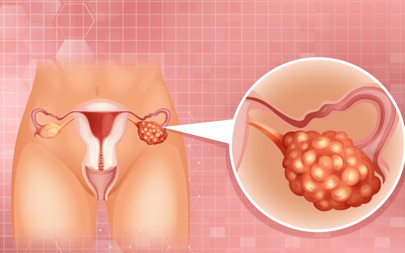 Polikistik Over Sendromu 1