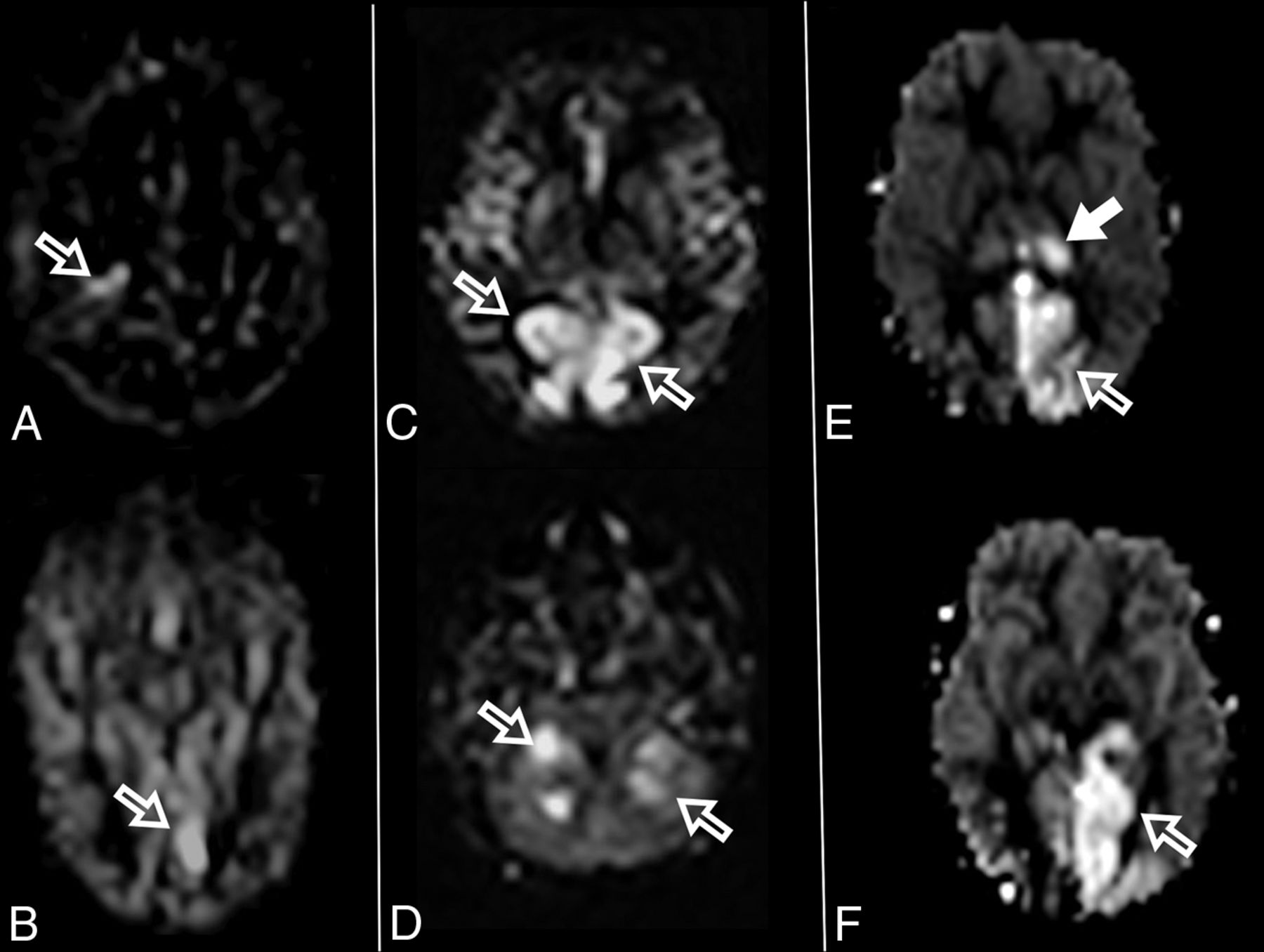 Polg Disease (1)