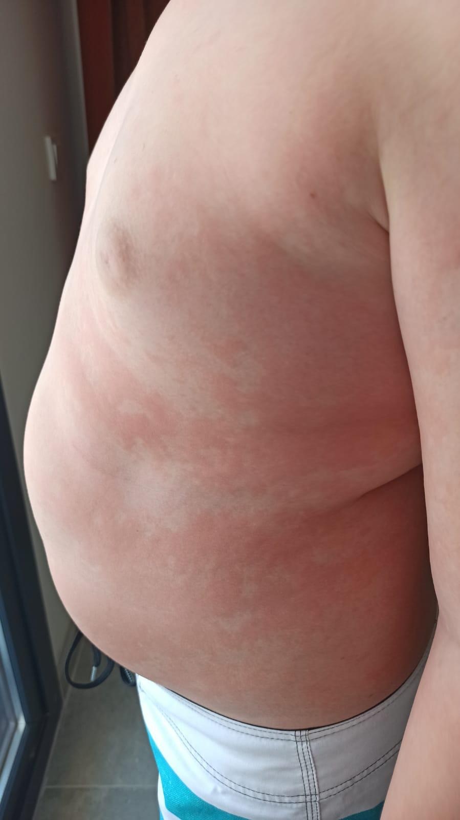 Besin Alerjileri (1)