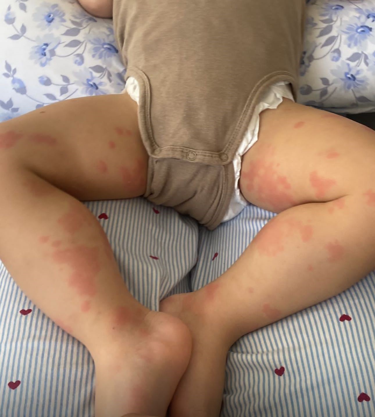 Besin Alerjileri (2)