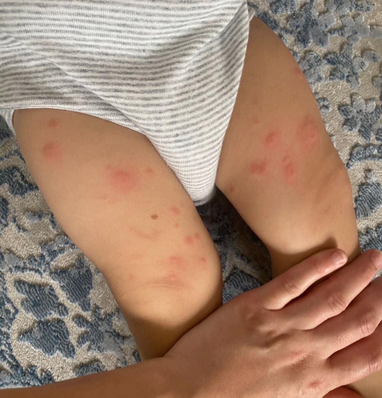 Besin Alerjileri (3)