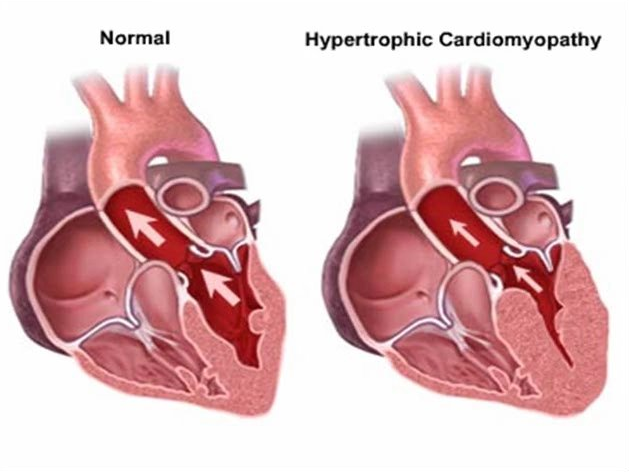 Hypercardio