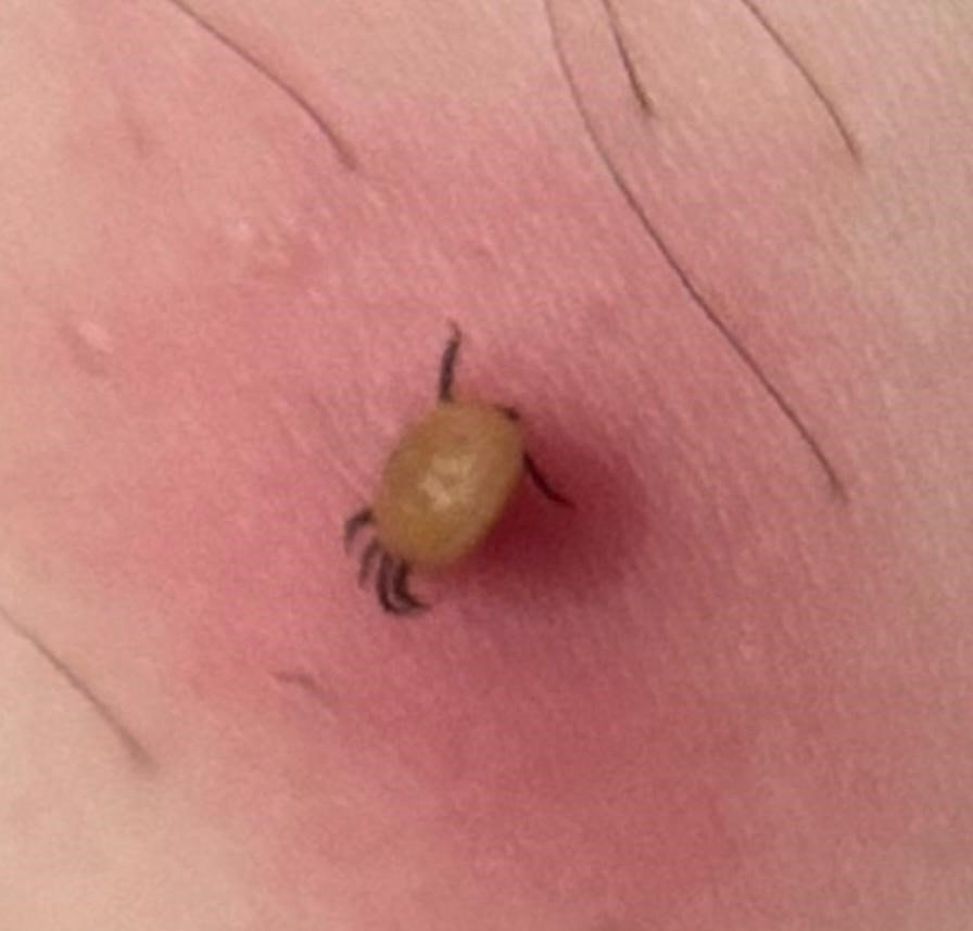 Kene Isırığı (1)