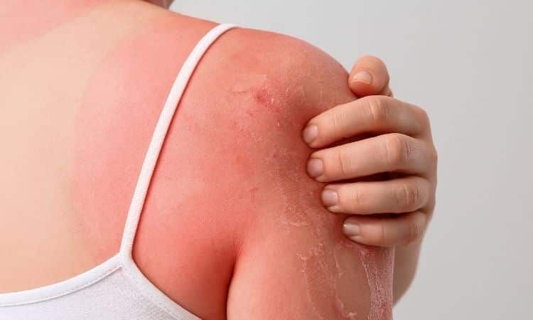 Gunes Zehirlenmesi.jpg3