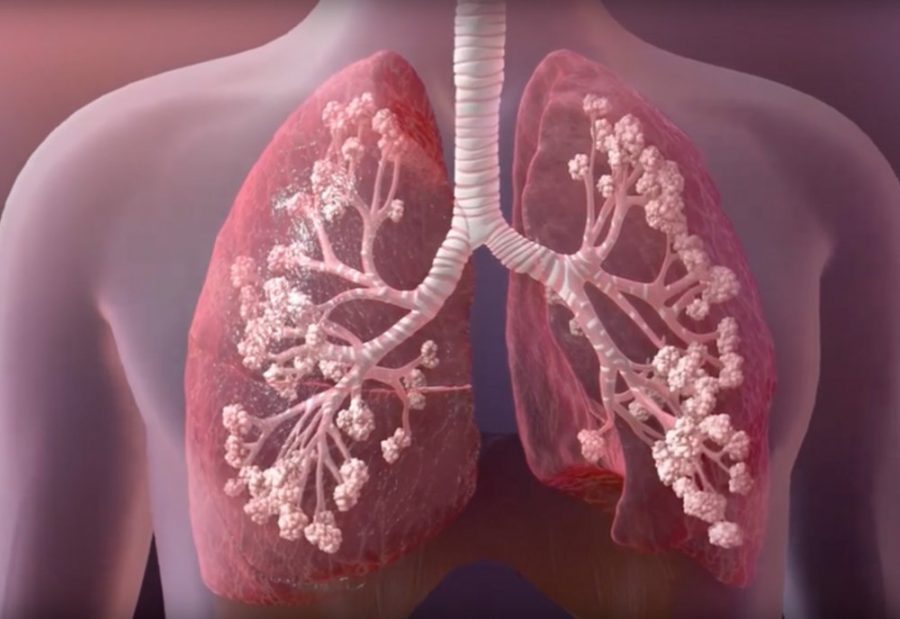 Kistik Fibrozis.jpg2