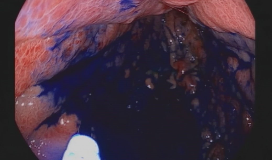 Boyama Yöntemi Ile Mide Ve Bağırsak Kanserinde