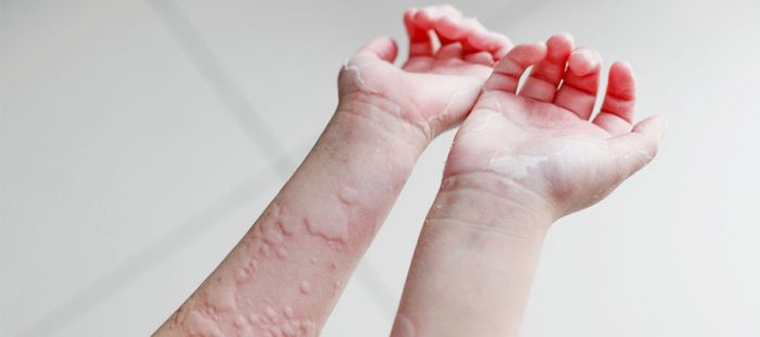 Kurdesen Belirtileri