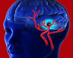 Serebral Anevrizma