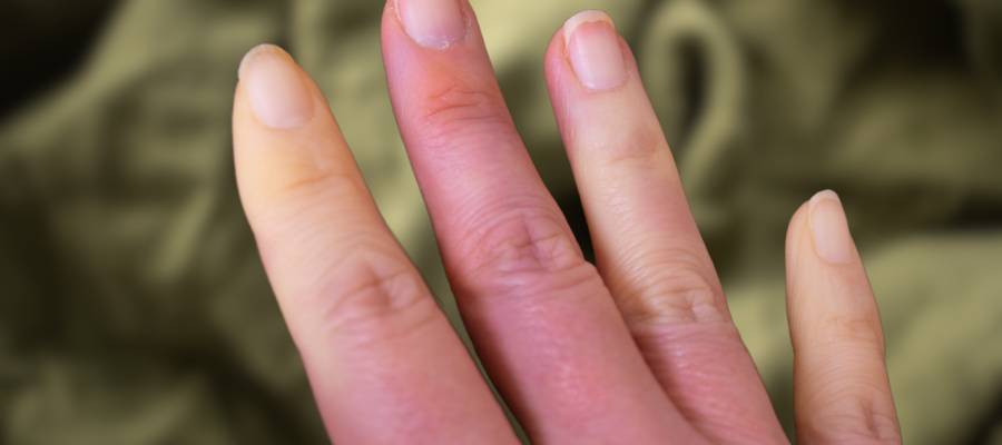 Raynaud Hastalığı.png2