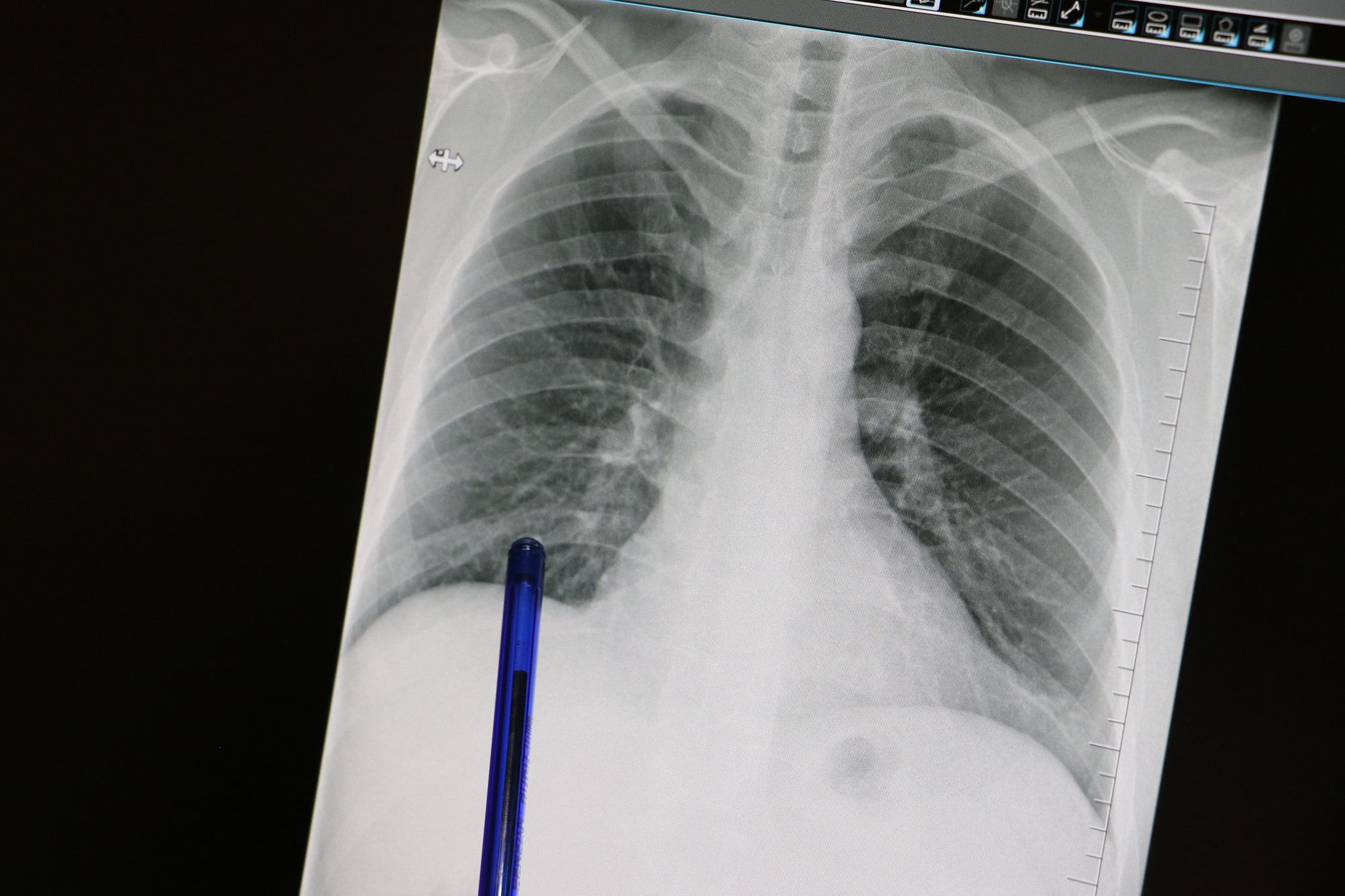 Akciğer Kanseri (1)-2