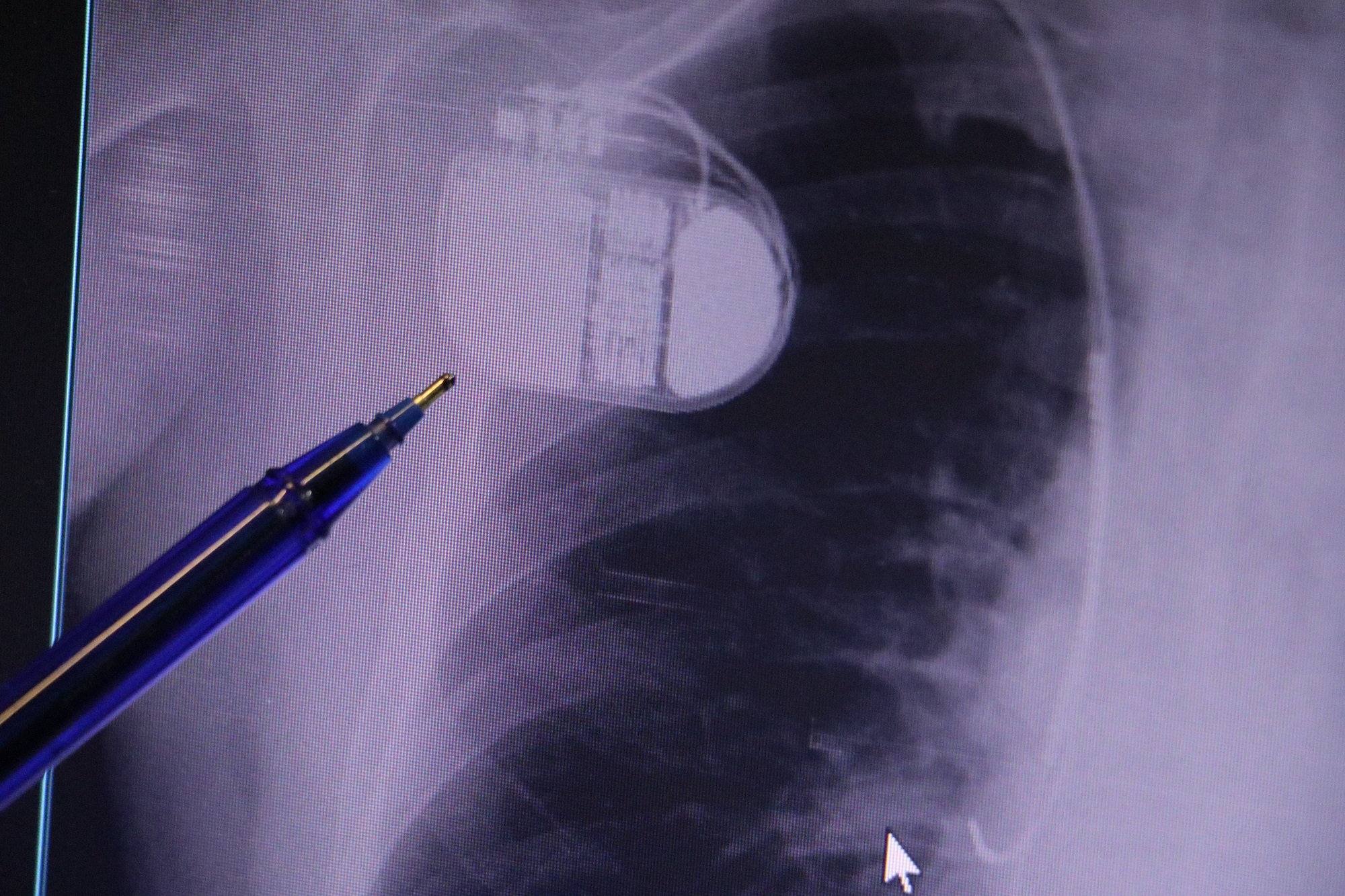 Kalp Hastalığı (1)