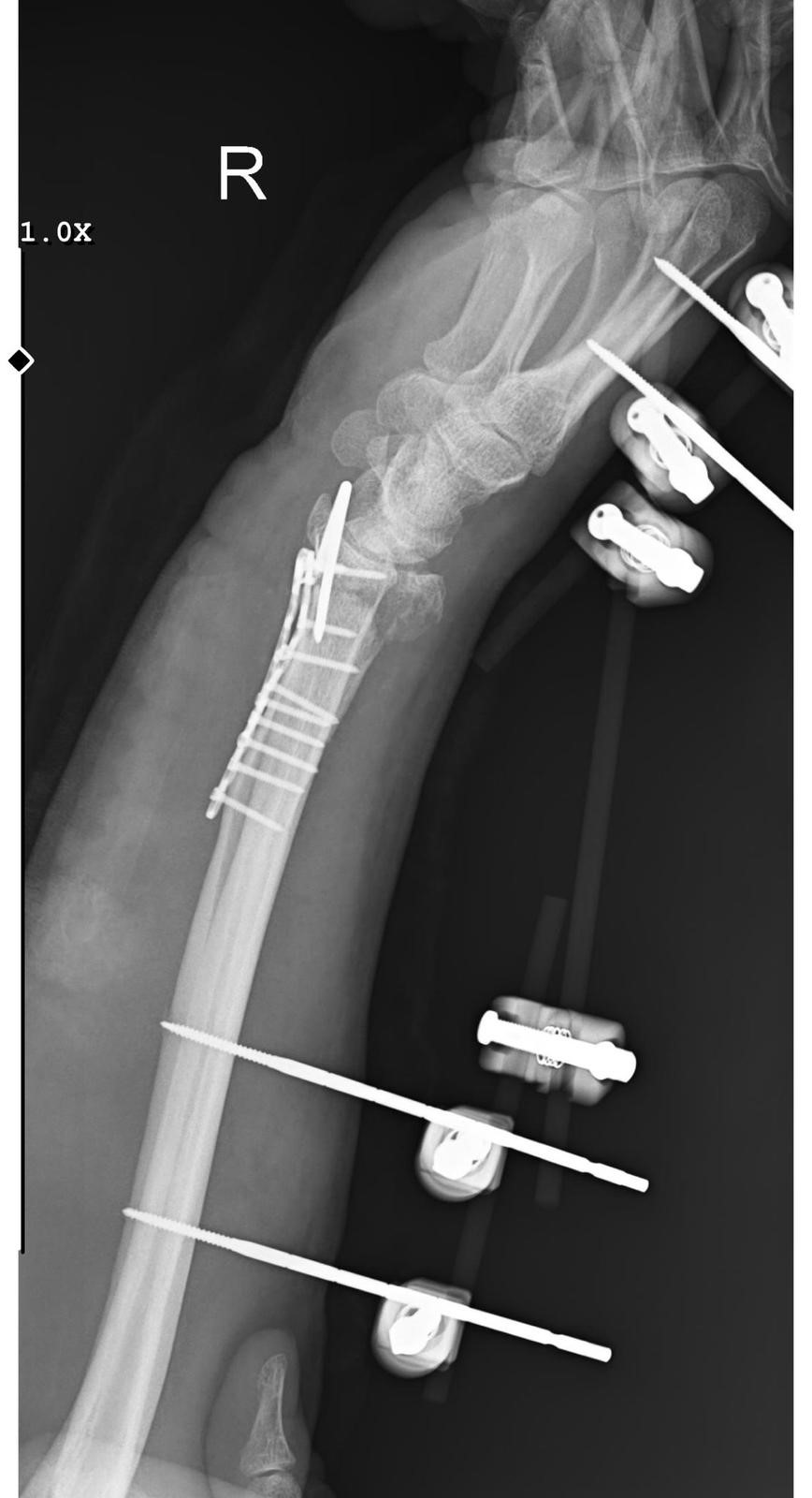 Ankara’da sahipsiz köpeklerden kaçarken düştü - 2